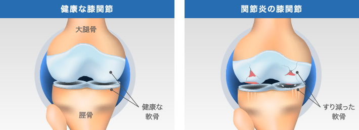 健康な膝関節と、軟骨のすり減りが見られる膝関節