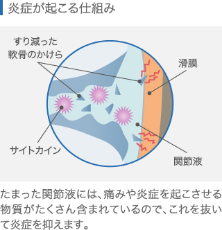 ひざ関節で炎症が起こる仕組み