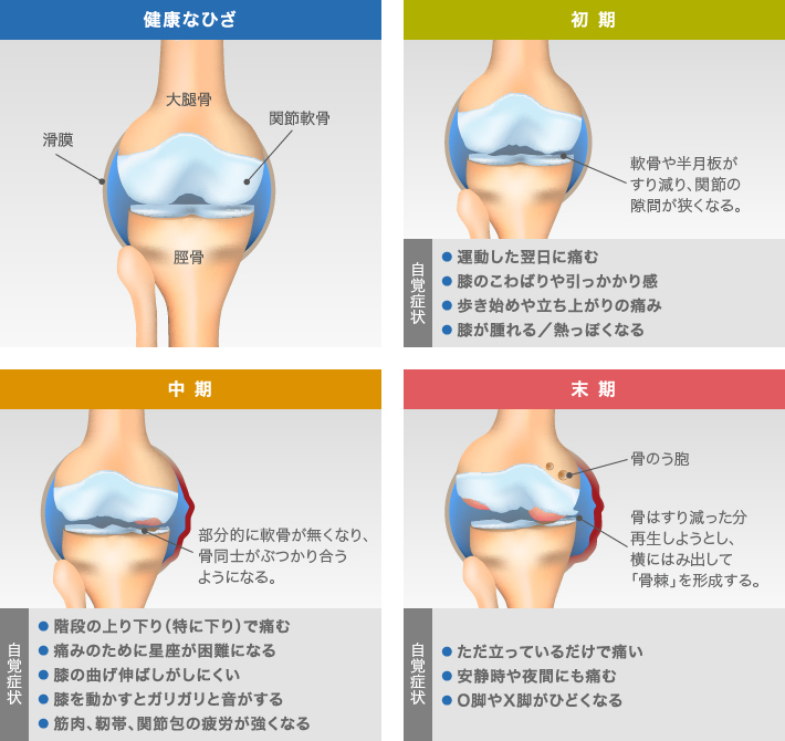 膝軟骨がすり減る過程