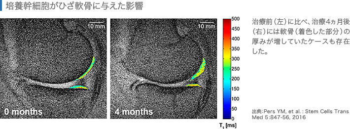 培養幹細胞がひざ軟骨に与えた影響