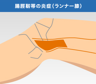 腸脛靭帯の炎症（ランナー膝）①