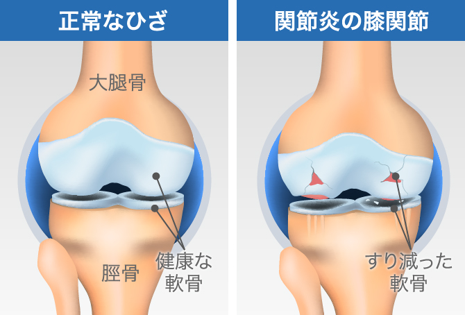 膝軟骨の すり減り どう対処すべき 原因と治療法 整形外科医監修コラム ひざ関節症クリニック