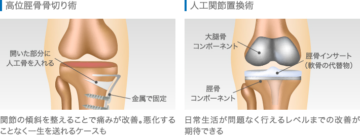 高位脛骨骨切り術・人工関節置換術