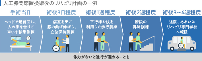 人工関節置換術後のリハビリ計画の一例