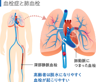 血栓症と肺血栓