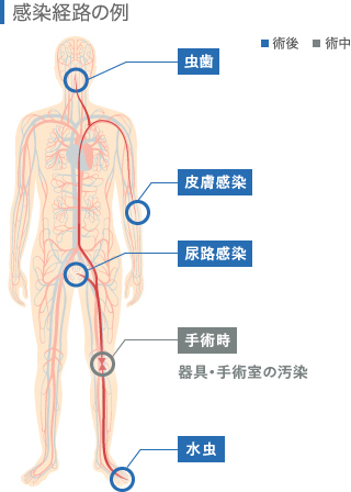 感染経路の例