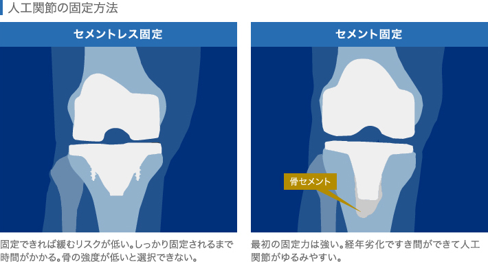 人工関節の固定方法