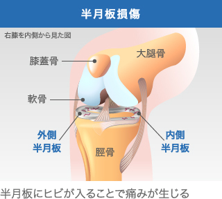 半月板損傷