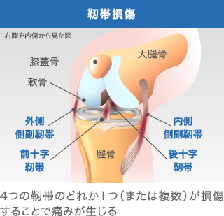 靭帯損傷