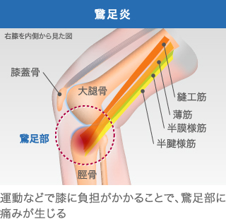 鵞足炎