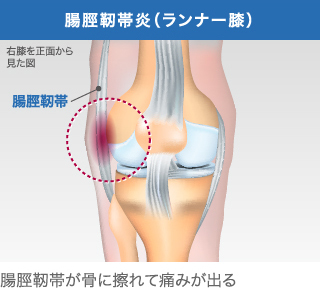 腸脛靭帯炎（ランナー膝）