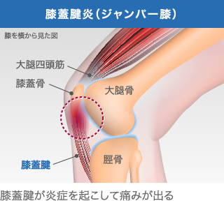 膝蓋腱炎（ジャンパー膝）