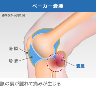 ベーカー嚢腫