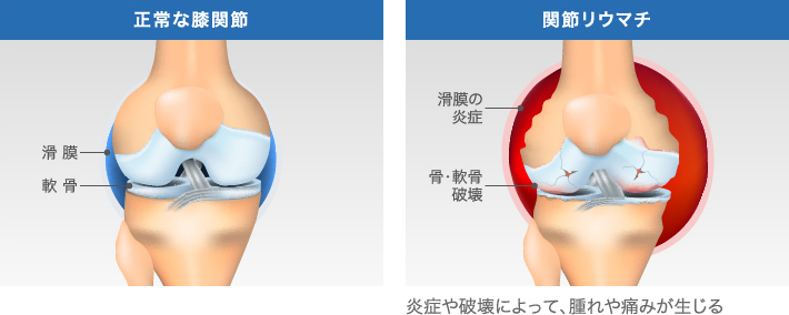 通常の膝関節と関節リウマチ