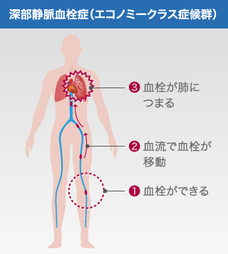 深部静脈血栓症（エコノミークラス症候群）