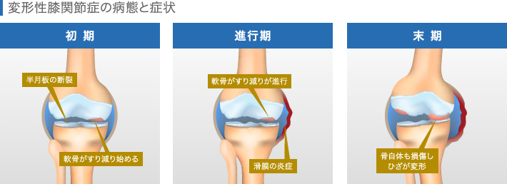 変形性膝関節症の病態と症状