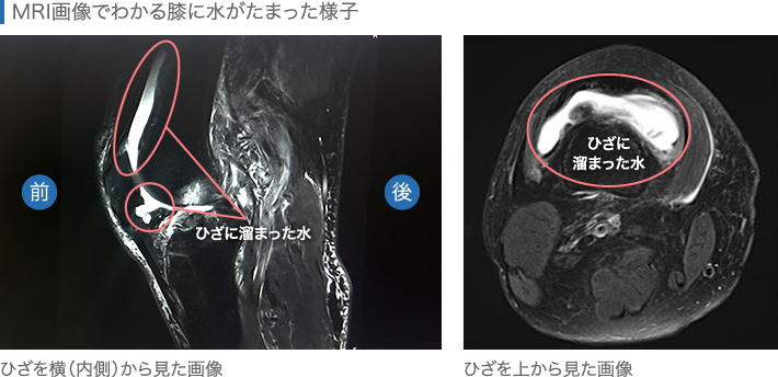 MRI画像でわかる膝に水がたまった様子