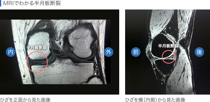 MRIでわかる半月板断裂