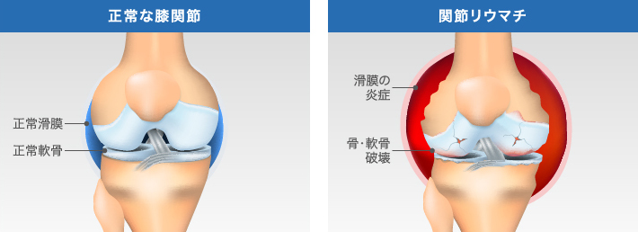 正常な膝関節と関節リウマチの比較