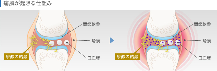 痛風が起きる仕組み