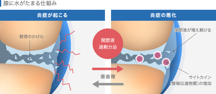 膝に水がたまる仕組み