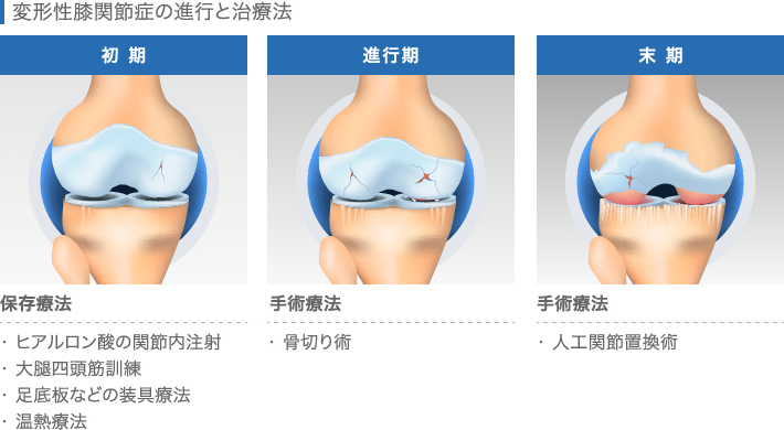 変形性膝関節症の進行と治療法