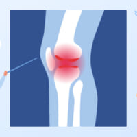 膝の腫れたらどうすべき? 考えられる病気と原因別対処法