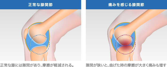 正常な膝関節と痛みを感じる膝関節の比較