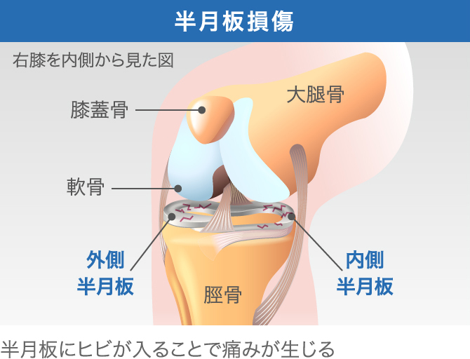 膝が急に痛くなる原因は 考えられる10の原因とその解決法