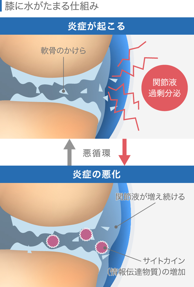 膝の腫れたらどうすべき 考えられる病気と原因別対処法
