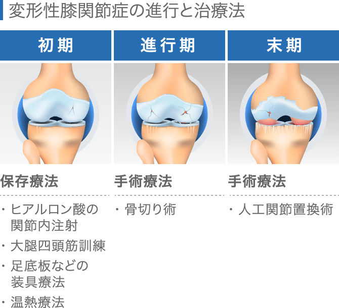 膝が腫れたらどうすべき 考えられる病気と原因別対処法