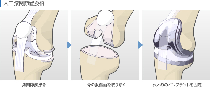 人工膝関節置換術