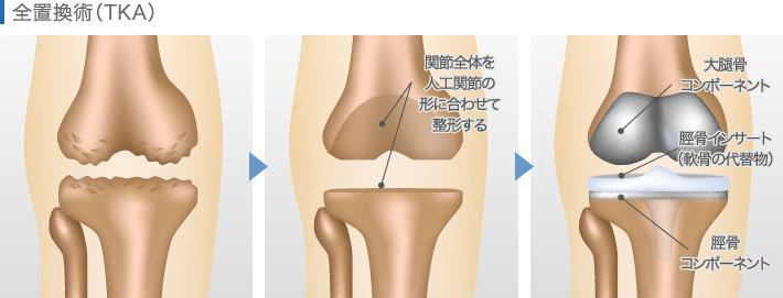 全置換術（TKA）