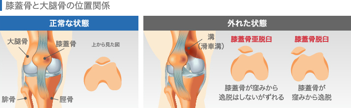 膝蓋骨と大腿骨の位置関係