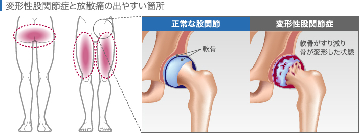 変形性膝関節症と放散痛の出やすい箇所