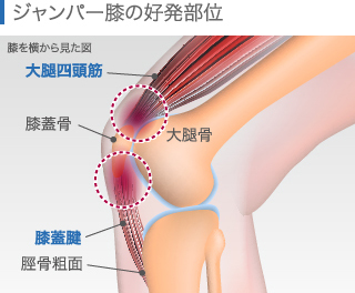 ジャンパー膝の好発部位