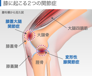 膝に起こる２つの関節症