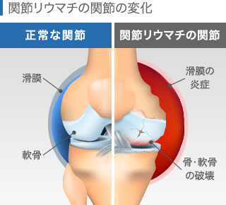 関節リウマチの関節の変化