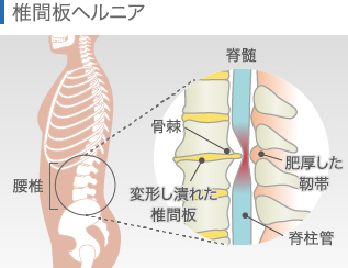 椎間板ヘルニア