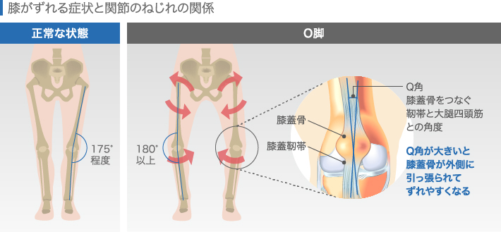 膝がずれる症状と関節のねじれの関係