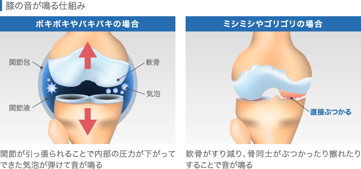膝の音が鳴る仕組み