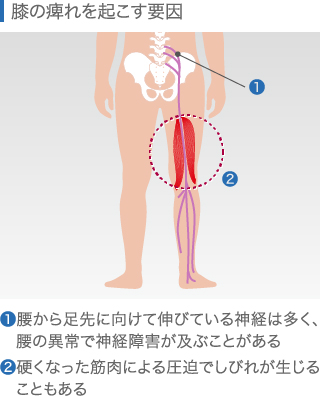 膝のしびれを起こす要因