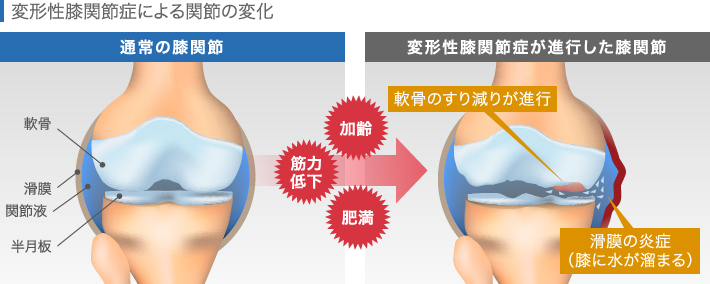 変形性膝関節症による関節の変化