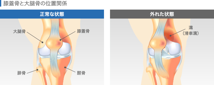 膝蓋骨と大腿骨の位置関係
