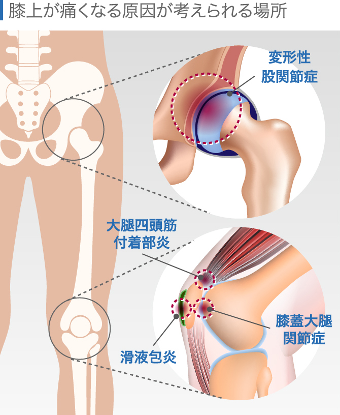 膝上が痛い原因はジャンパー膝以外にも セルフケアや治療法を全解説