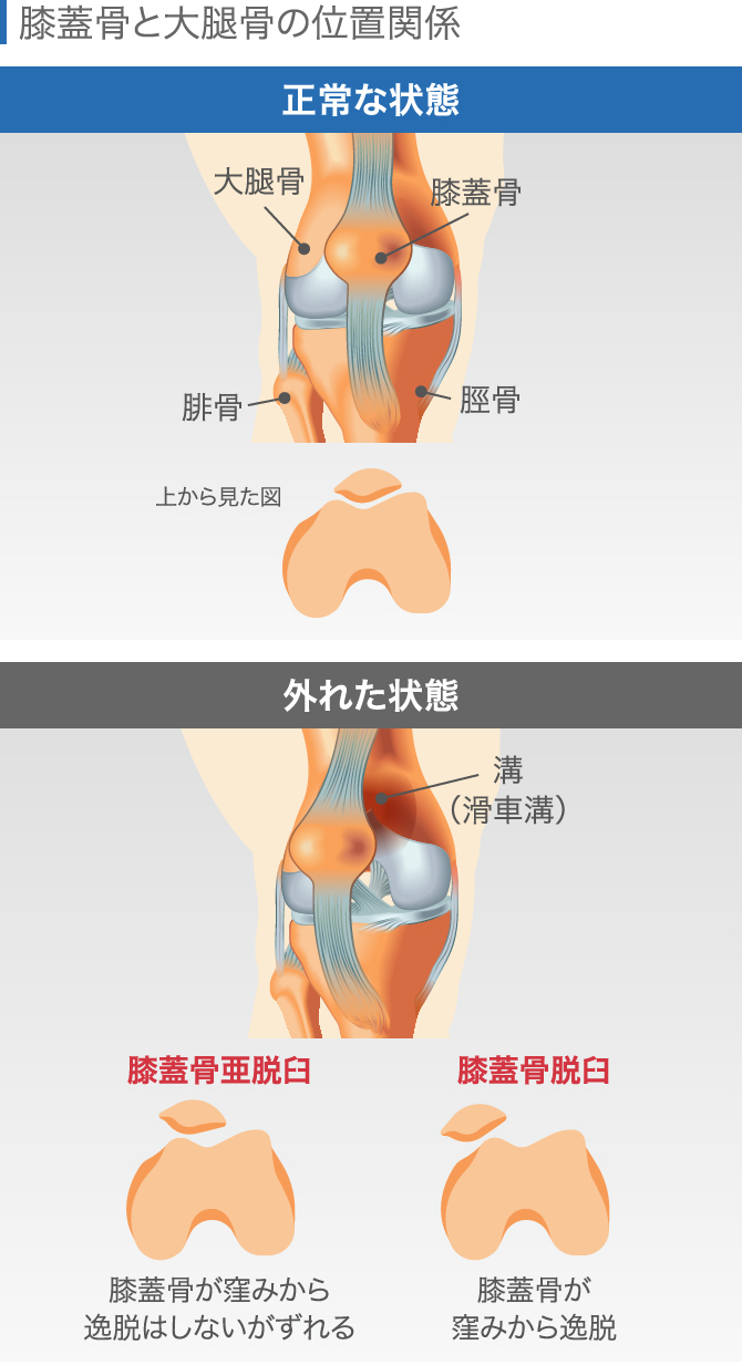 膝 の 上 が 痛い