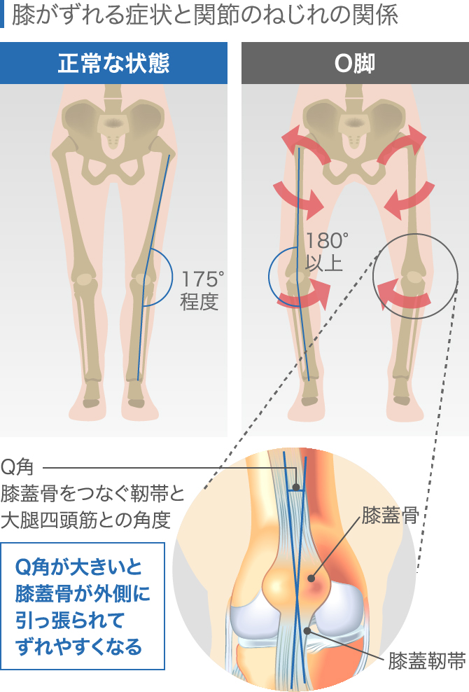 膝の違和感の症状チェック 痛くないけど気になる原因と対処法 膝の違和感の症状チェック 痛くないけど気になる原因と対処法