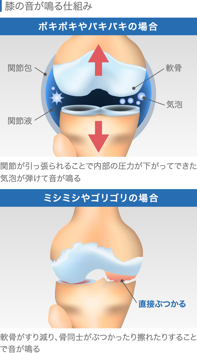 膝の違和感の症状チェック 痛くないけど気になる原因と対処法 膝の違和感の症状チェック 痛くないけど気になる原因と対処法