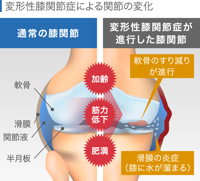 膝の違和感の症状チェック 痛くないけど気になる原因と対処法 膝の違和感の症状チェック 痛くないけど気になる原因と対処法