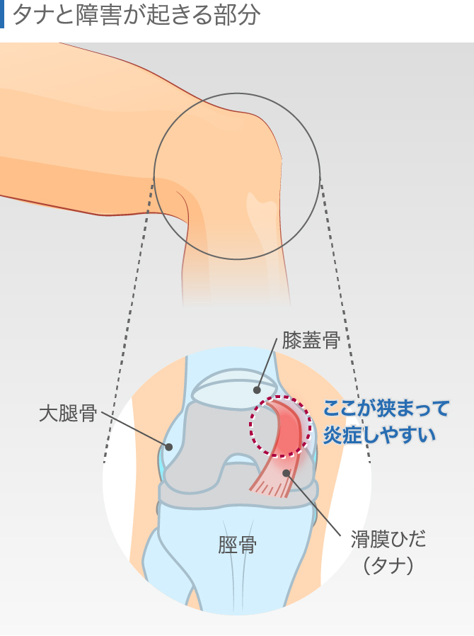 膝の違和感の症状チェック 痛くないけど気になる原因と対処法